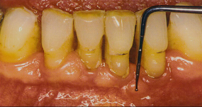Instrumentet vist uden på tandkødet på en patient med paradentose.
