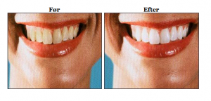 før-efter billede tandblegning